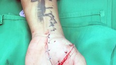 Xuyên đêm "cứu sống” bàn tay một nam thanh niên bị đứt lìa