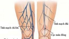 Dấu hiệu cần đi khám bệnh tắc động mạch chi dưới mạn tính
