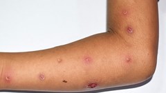 Nhanh chóng triển khai công tác phòng, chống dịch bệnh đậu mùa khỉ