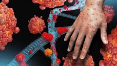 Không bất ngờ, bị động với bệnh đậu mùa khỉ