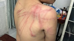 Lâm Đồng tạm giữ hình sự người cha bạo hành con ruột