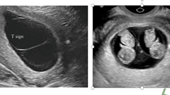 Song thai cùng trứng nhưng khác kiểu gen và giới tính: Bằng chứng khoa học mới trong ngành Sản phụ khoa