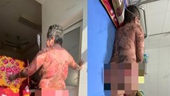 Suýt mất mạng vì tự ý sử dụng thuốc nam không rõ nguồn gốc