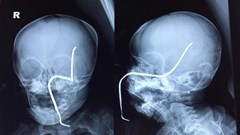 Tai nạn bất ngờ gây nguy hiểm tính mạng