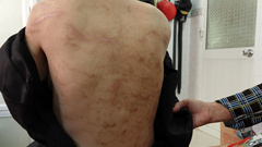 Để không còn những nỗi đau! (Bài 1): Gần 2 năm, hơn 200 vết sẹo nhưng không ai biết (?!)