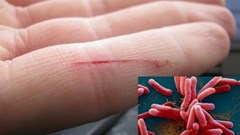 Quảng Nam chỉ đạo tăng cường  công tác chẩn đoán và điều trị bệnh Whitmore