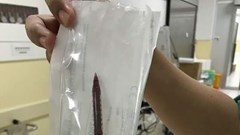 Chạy bị ngã, bé gái bốn tuổi bị bút bi đâm xuyên ngực