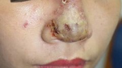 Hoại tử mũi vì tiêm filler làm đẹp