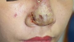 Hoại tử mũi vì tiêm filler làm đẹp
