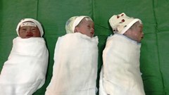 Nghệ An: Đỡ đẻ thành công sản phụ sinh 3 do mang thai tự nhiên hiếm gặp