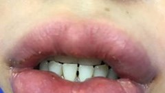 Sưng vù môi vì... làm đẹp