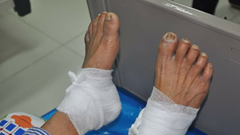 Bị bỏng vì chườm nóng bằng lá ngải cứu