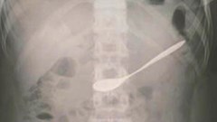 Gắp thành công chiếc thìa ra khỏi dạ dày bệnh nhân