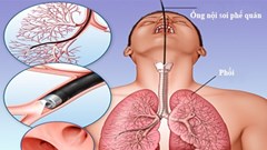 Bệnh nhân tử vong khi nội soi phế quản, Bệnh viện Bạch Mai nói gì?