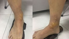 Bỏng vì đi… mát-xa