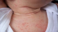 Sử dụng lá tắm khiến bệnh của trẻ trở nên nặng hơn