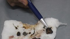 Quảng Nam: Gắp lưỡi câu, bánh xe quẹt gas, kim loại gỉ từ phổi bệnh nhân