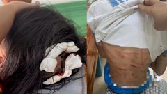 Công an Hà Tĩnh triệu tập cha dượng nghi bạo hành bé gái