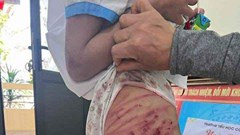 Làm rõ vụ bé gái ở Hà Tĩnh nghi bị cha dượng bạo hành