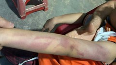 Bé gái lớp 2 bị bạn đánh bầm tím vì “hứa cho kẹo nhưng không thực hiện”