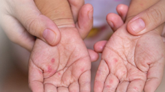 Bộ Y tế cảnh báo nguy cơ bùng phát dịch tay chân miệng và sốt xuất huyết