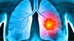 AI trở thành “mắt thần” giúp tầm soát ung thư phổi 