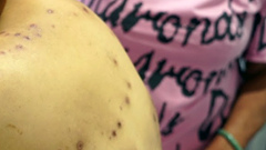 Cứu sống người phụ nữ bị ong vò vẽ đốt 70 vết, gây sóc phản vệ