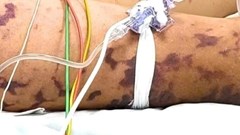 Ghi nhận 2 ca viêm não mô cầu ở Cà Mau, 1 trường hợp tử vong