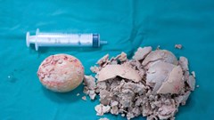 Bệnh viện Hùng Vương Gia Lai phẫu thuật thành công sỏi bàng quang “khổng lồ” hơn 10cm