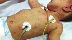 Cảnh báo não mô cầu đầu năm học