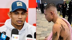 Tuyển thủ Malaysia bị tạt axit