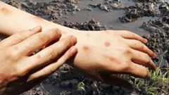 Bộ Y tế cảnh báo về bệnh “sốt đất” khiến 732 ca nhiễm, 23 trường hợp tử vong tại Thái Lan