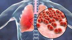 Những biến chứng nguy hiểm của cúm A nếu không phát hiện và điều trị kịp thời