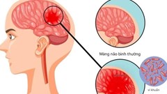 Bệnh não mô cầu xuất hiện trong trường học: Những dấu hiệu phụ huynh không thể bỏ qua
