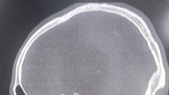 Mũi khoan cong xuyên mũi: Ca mổ “nín thở” cứu sống nam công nhân