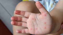 Bệnh tay chân miệng tăng khi trẻ trở lại trường
