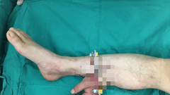 Bác sĩ cứu bàn tay bị đứt lìa của người bệnh bằng cách ghép vào chân