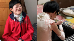 Từng bị chẩn đoán không sống quá 2 tuổi, “cô gái bươm bướm” hiện tại ra sao ở tuổi 25?