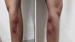 Cận cảnh đôi chân của cô gái 29 tuổi sau tiêm filler thẳng chân tại nhà