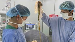 Phẫu thuật lấy búi tóc khổng lồ khỏi dạ dày bé trai 6 tuổi ở Đà Nẵng
