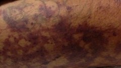 Thanh niên 32 tuổi nhiễm liên cầu lợn khi giết mổ lợn bệnh