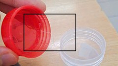 Gắp ký sinh trùng dài gần 10cm trong mắt người bệnh