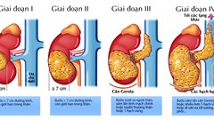 Hút thuốc lá làm tăng 50% nguy cơ mắc ung thư thận