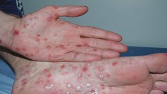 Hy hữu bệnh nhi 3 tuổi được phát hiện mắc bệnh giang mai bẩm sinh