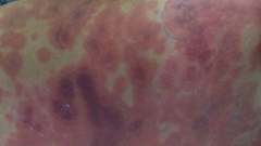 4 trường hợp tử vong vì viêm não mô cầu