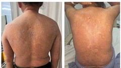 “Thảm họa” bôi thuốc trị bệnh nấm da không rõ nguồn gốc