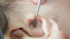 Trong nhà nuôi nhiều thú cưng, bọ chét ký sinh trên màng nhĩ bé gái 2 tuổi
