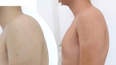 Điều trị gù lưng không cần phẫu thuật