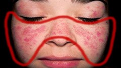 Bệnh nhân lupus ban đỏ nhận TIN VUI ngay đầu năm mới