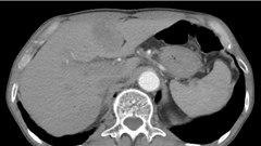 Sỏi mật có thể gây ung thư nếu không được điều trị sớm